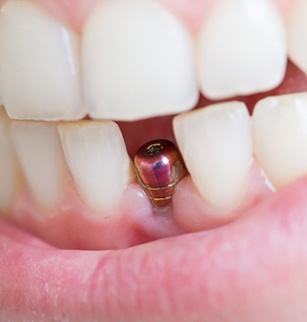 A closeup of a single dental implant and its abutment