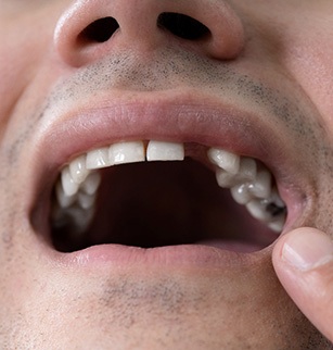 A closeup of a mouth with missing teeth