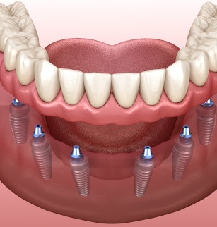 Digital illustration of implant dentures