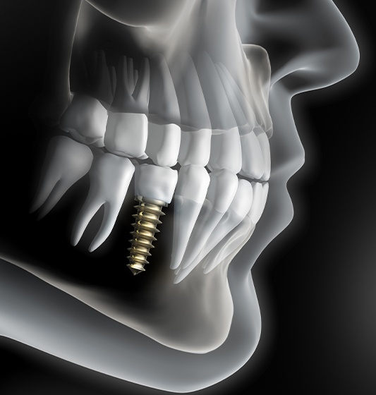 Animated smile with dental implant supported dental crown